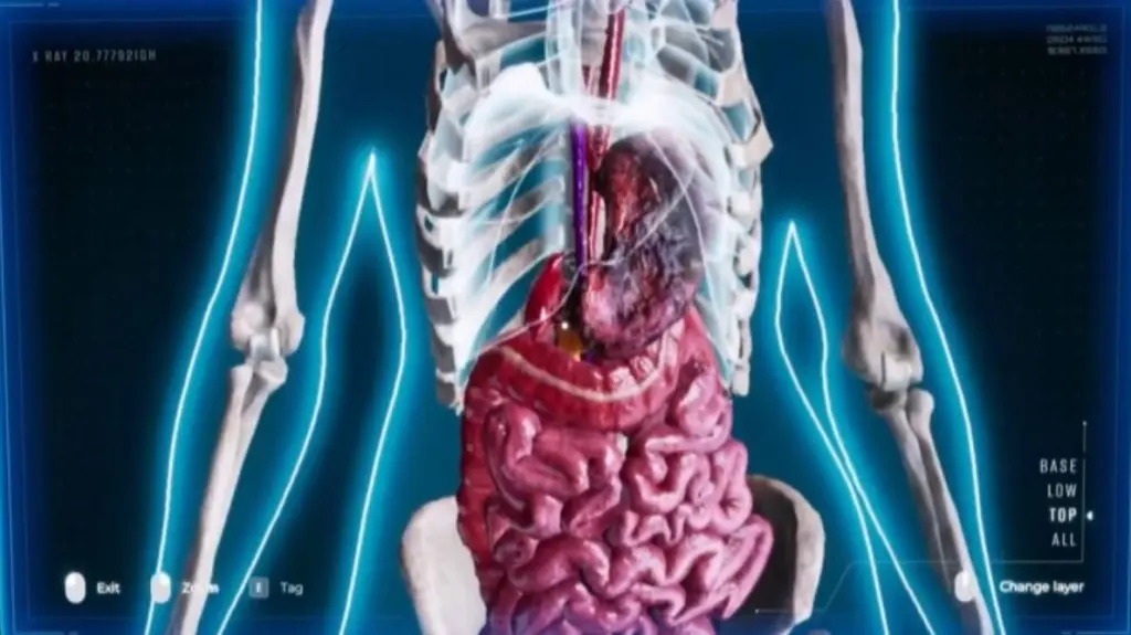 necrose no estômago, visível na radiografia