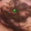Necrose na bochecha